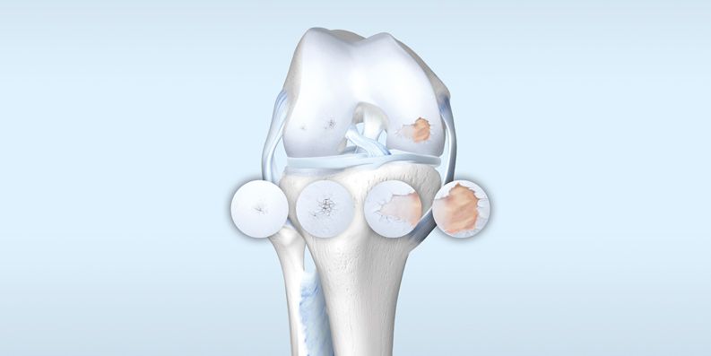 Arthrose: Diagnostik und Therapie - arztCME: Zertifizierte Fortbildung 
