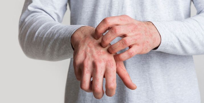 Chronisches Handekzem