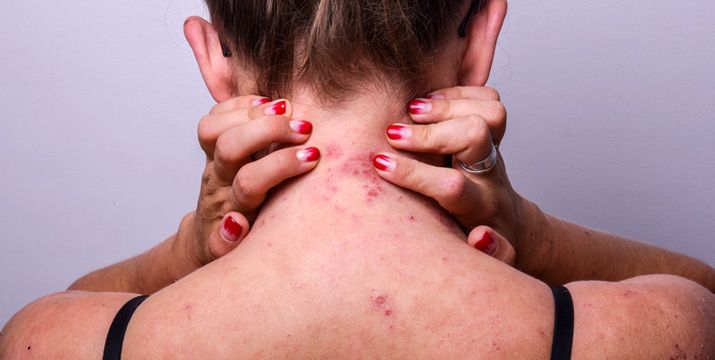 Atopische Dermatitis – Sonderlokalisationen Head & Neck und Genitalien