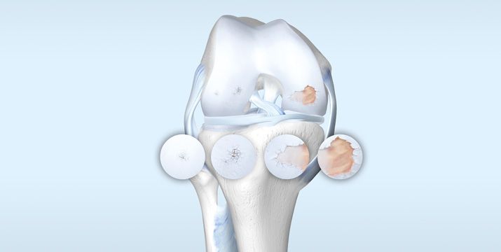 Arthrose: Diagnostik, Therapie