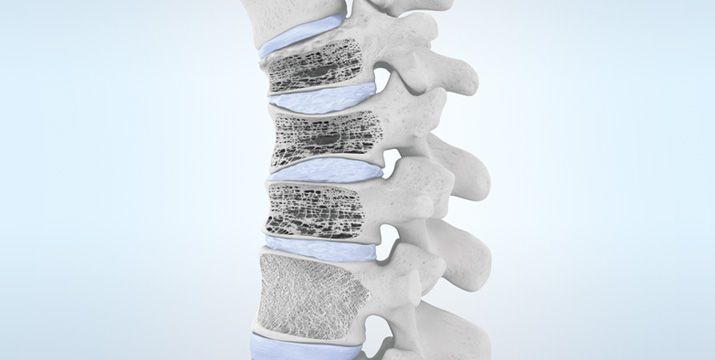 Osteoporose – Diagnostik und Therapie mit Berücksichtigung der S3-Leitlinie 2023