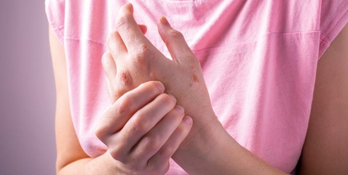 Chronisches Handekzem bei Jugendlichen