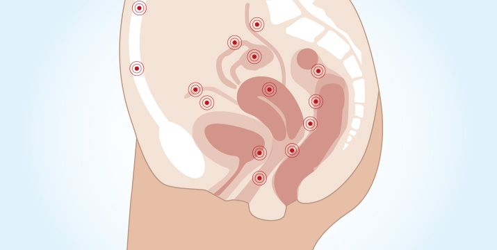 Endometriose – Leitlinien-Update 2025
